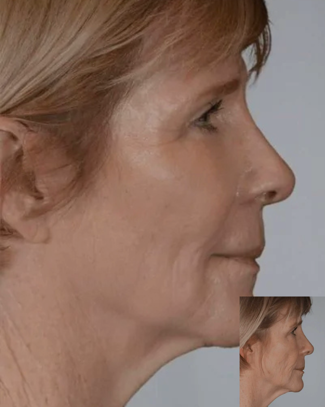 Fat Transfer
