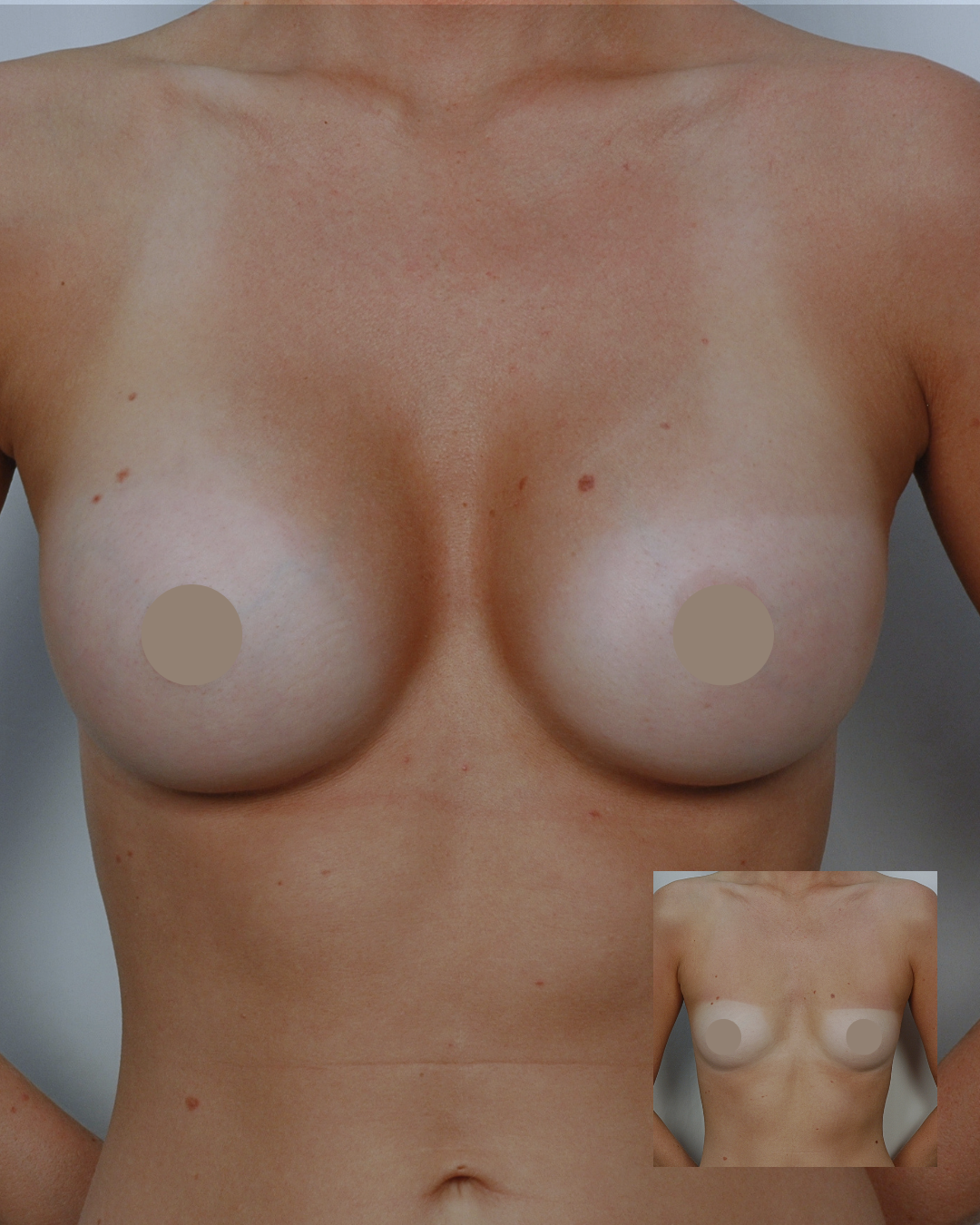 Breast Augmentation