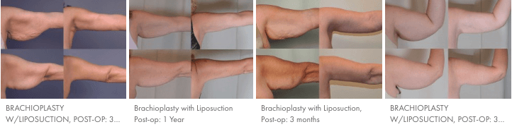 Brachioplasty Results Timelapse Comparison