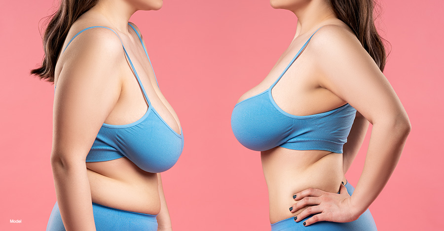 Result of a breast augmentation (cup size increase versus implant