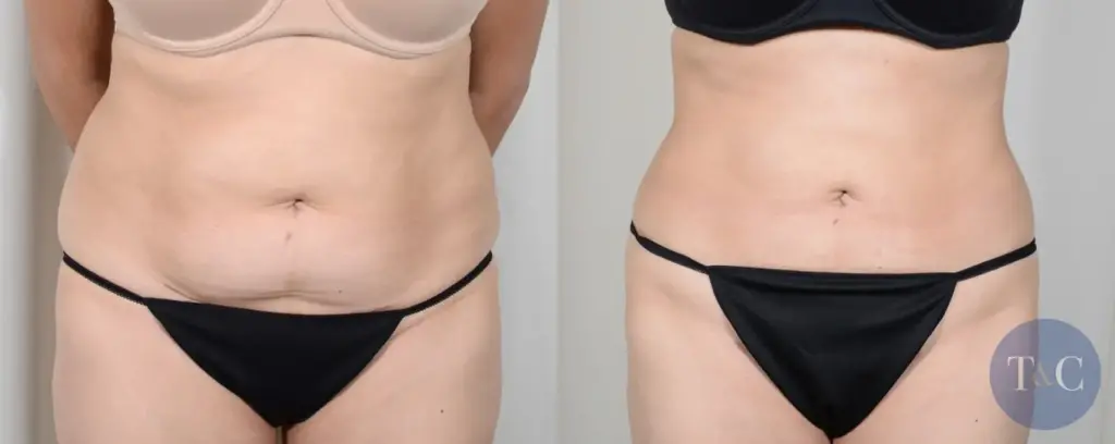 Before and after pictures of BodyTite® with liposuction patient