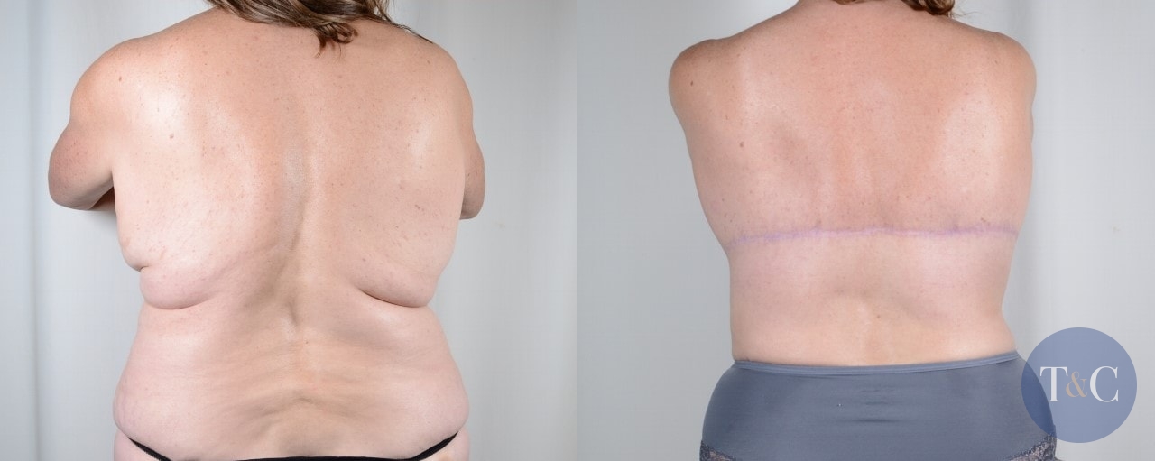 Body Contouring for Men Before and After Pictures Case 623, Houston, TX