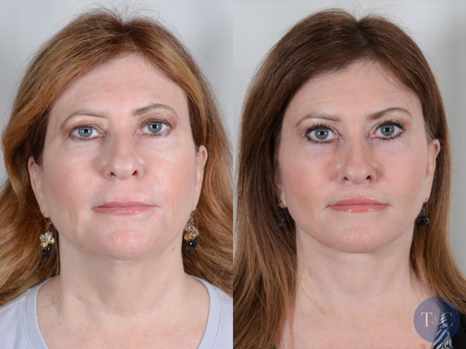 Facelift And Neck Lift Before And After Town And Country Plastic Surgeons And Medspa 