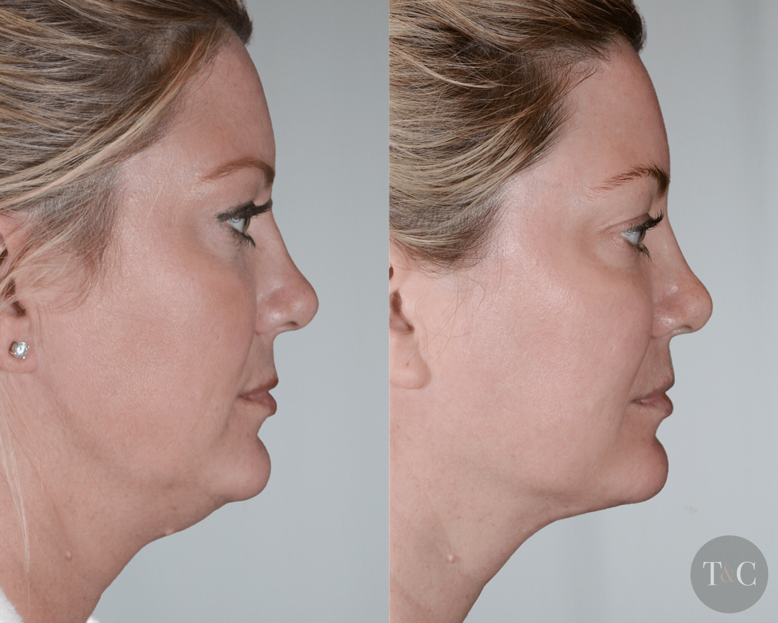 Facetite® Before And After Town And Country Plastic Surgeons And Medspa