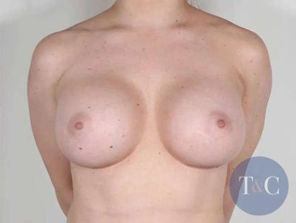 Breast Augmentation Before & After Patient #591