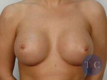 Breast Augmentation Before & After Patient #631