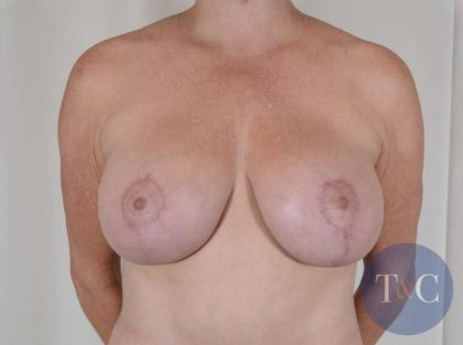 Breast Augmentation/Lift Before & After Patient #716