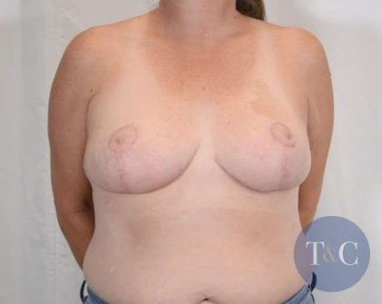 Breast Reduction Before & After Patient #776