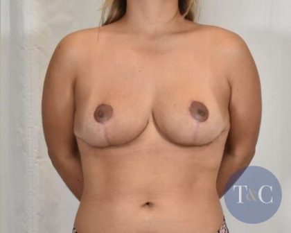 Breast Reduction Before & After Patient #846