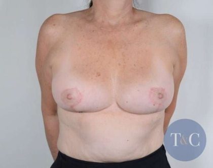 Breast Reduction Before & After Patient #861