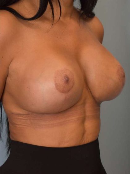 Breast Revision Before & After Patient #906