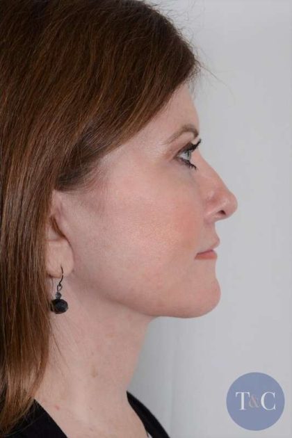 Facelift Before & After Patient #913