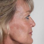 Facelift Before & After Patient #918