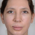 Facelift Before & After Patient #923