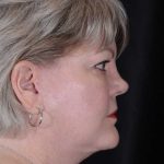 Facelift Before & After Patient #943