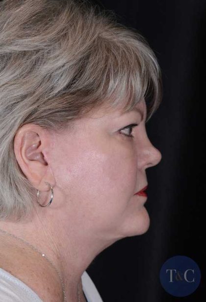 Facelift Before & After Patient #943