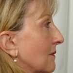 Facelift Before & After Patient #953