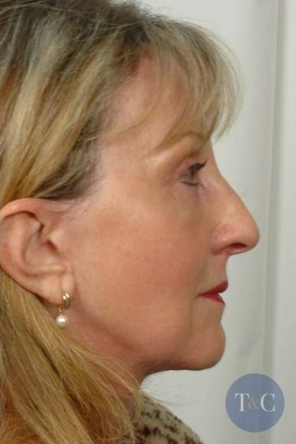 Facelift Before & After Patient #953