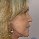 Facelift Before & After Patient #958