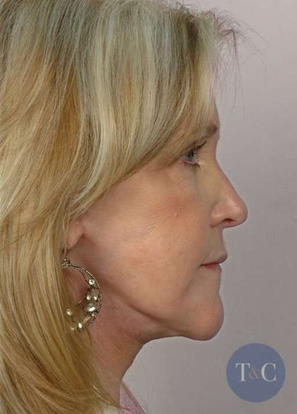 Facelift Before & After Patient #958