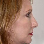 Facelift Before & After Patient #963