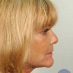 Facelift Before & After Patient #968