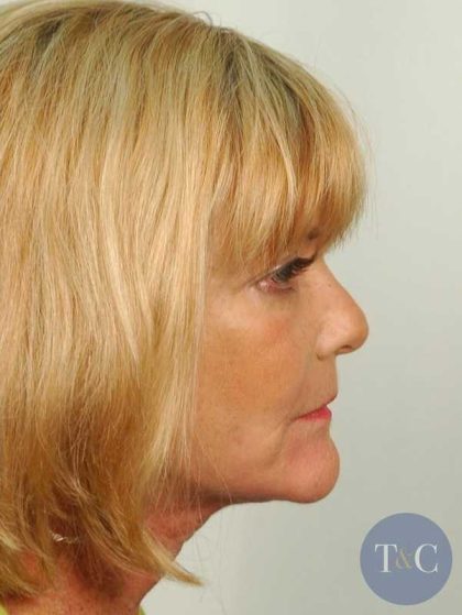 Facelift Before & After Patient #968