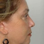 Facelift Before & After Patient #973