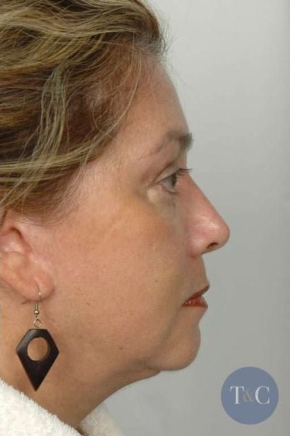 Facelift Before & After Patient #973