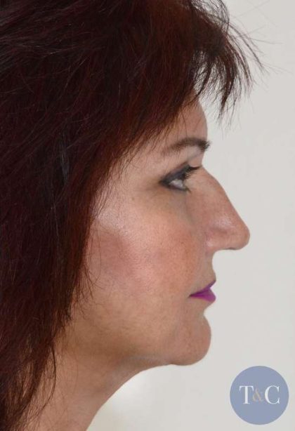 Facelift Before & After Patient #978