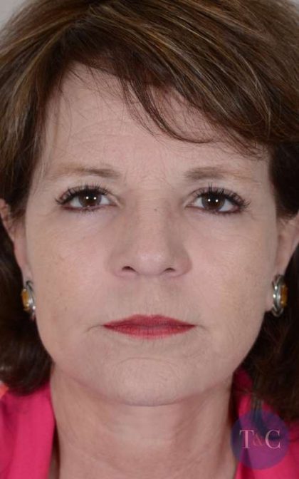 Facelift Before & After Patient #983