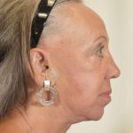 Facelift Before & After Patient #988