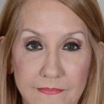 Facelift Before & After Patient #993