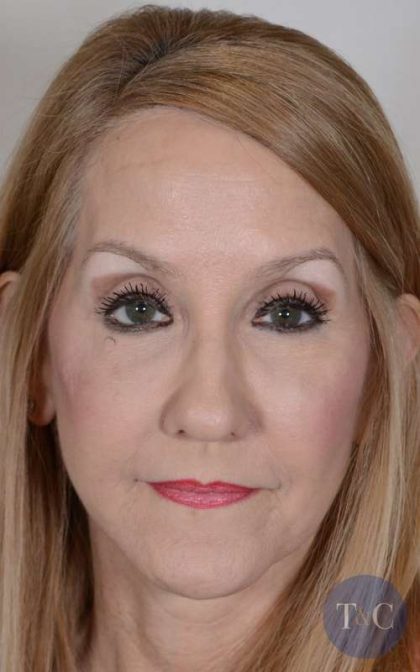 Facelift Before & After Patient #993