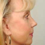 Facelift Before & After Patient #998