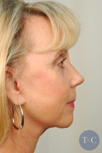 Facelift Before & After Patient #998