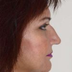 Facelift Before & After Patient #1003