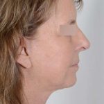 Facelift Before & After Patient #1008