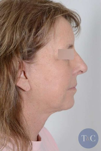 Facelift Before & After Patient #1008