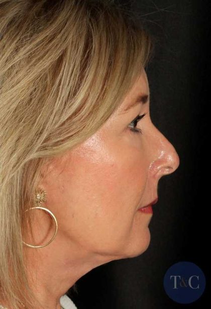 Facelift Before & After Patient #1013