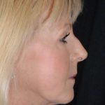 Facelift Before & After Patient #1018