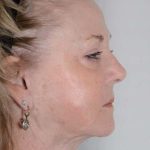 Facelift Before & After Patient #1023