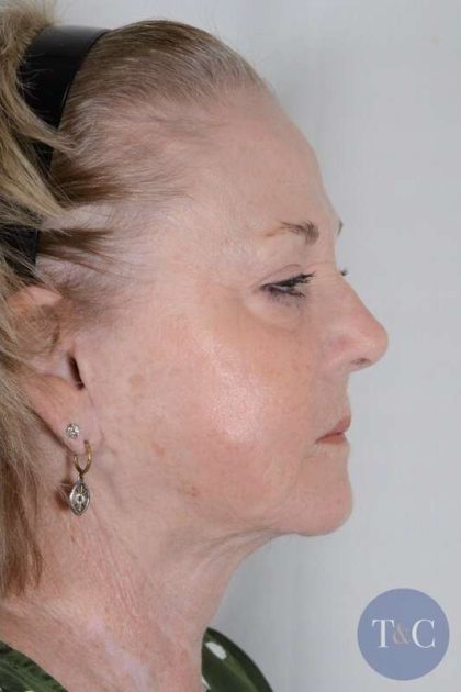 Facelift Before & After Patient #1023