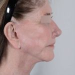 Facelift Before & After Patient #1028