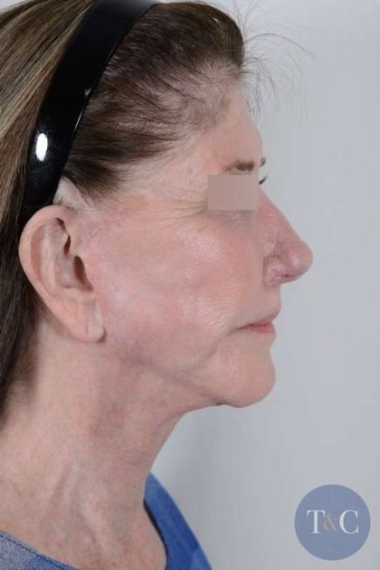 Facelift Before & After Patient #1028