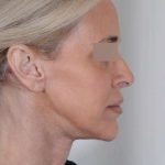 Facelift Before & After Patient #1033