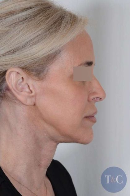 Facelift Before & After Patient #1033