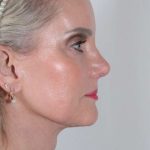 Facelift Before & After Patient #1038
