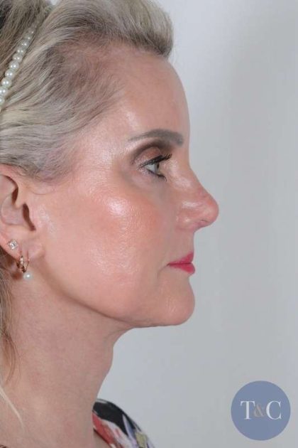 Facelift Before & After Patient #1038