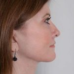 Facelift Before & After Patient #1043
